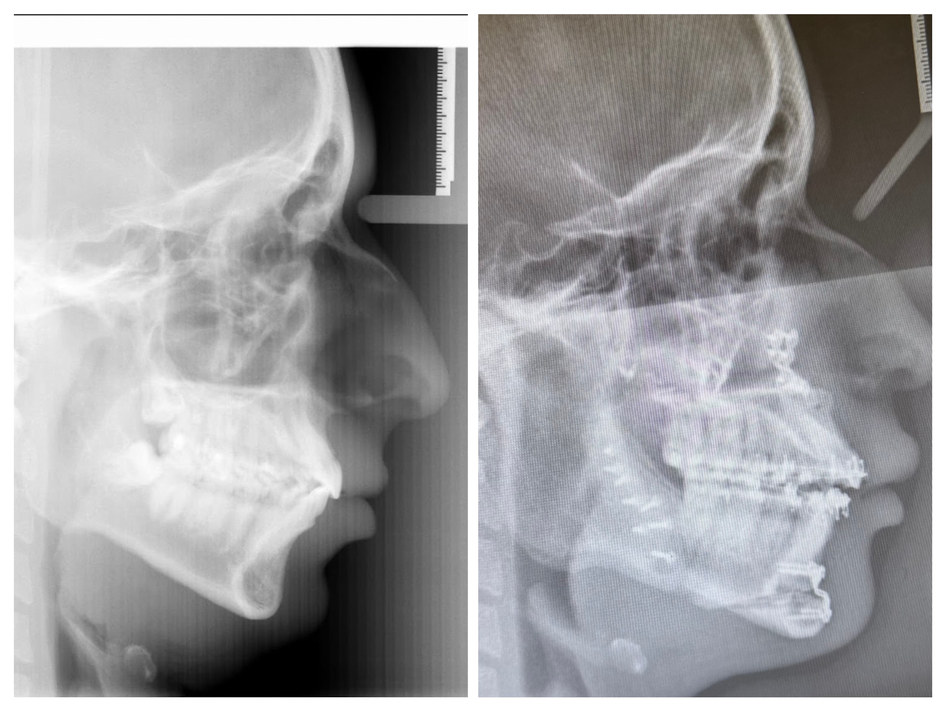 Side-by-side lateral cephalometric x-rays showing airway before and after maxillomandibular advancement surgery