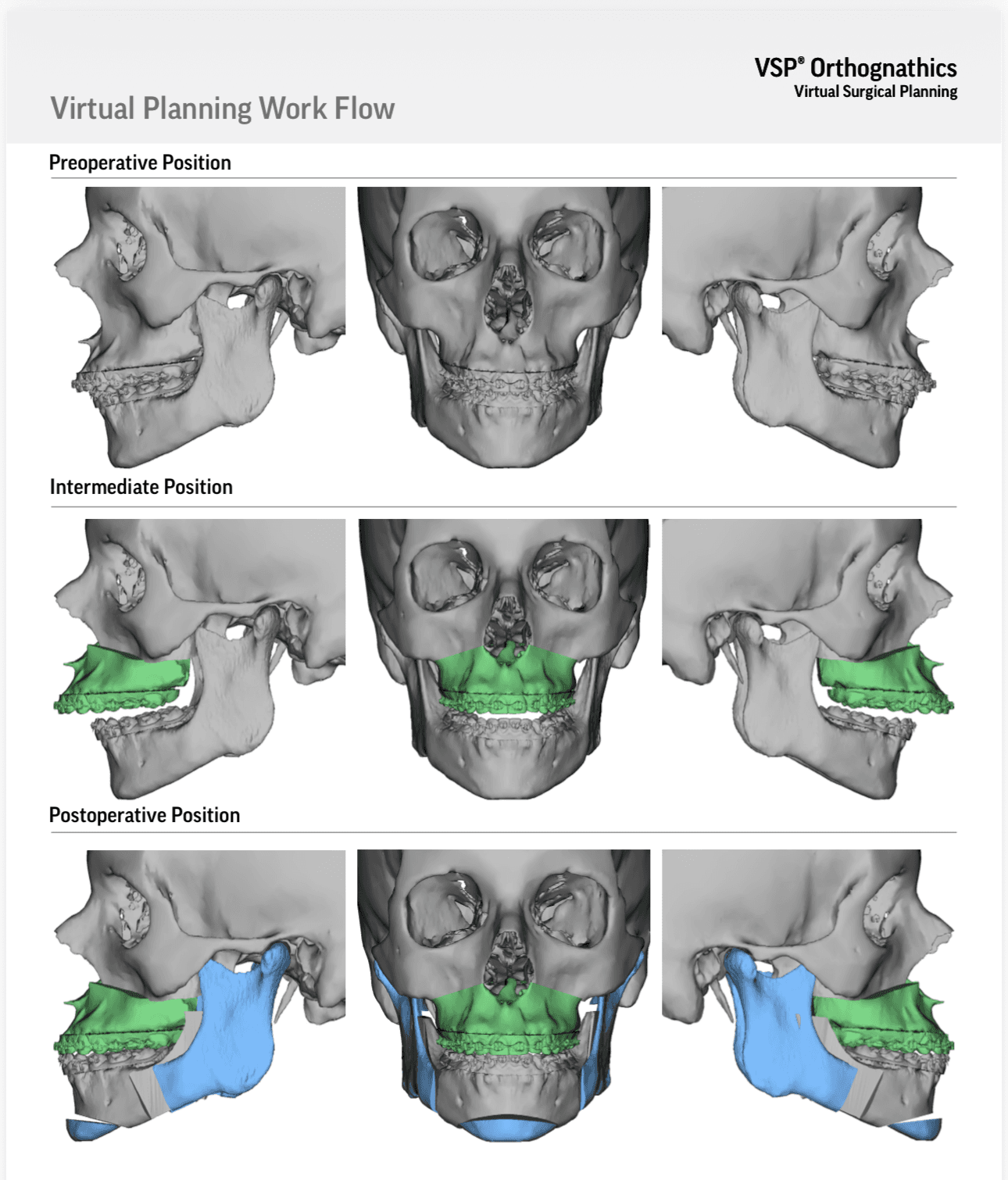 Virtual surgical planning file showing a patient's preoperative, intermediate, and postoperative jaw positions in frontal and lateral views